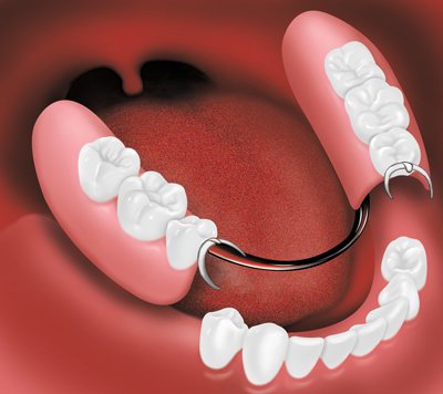 Image result for dental dentures