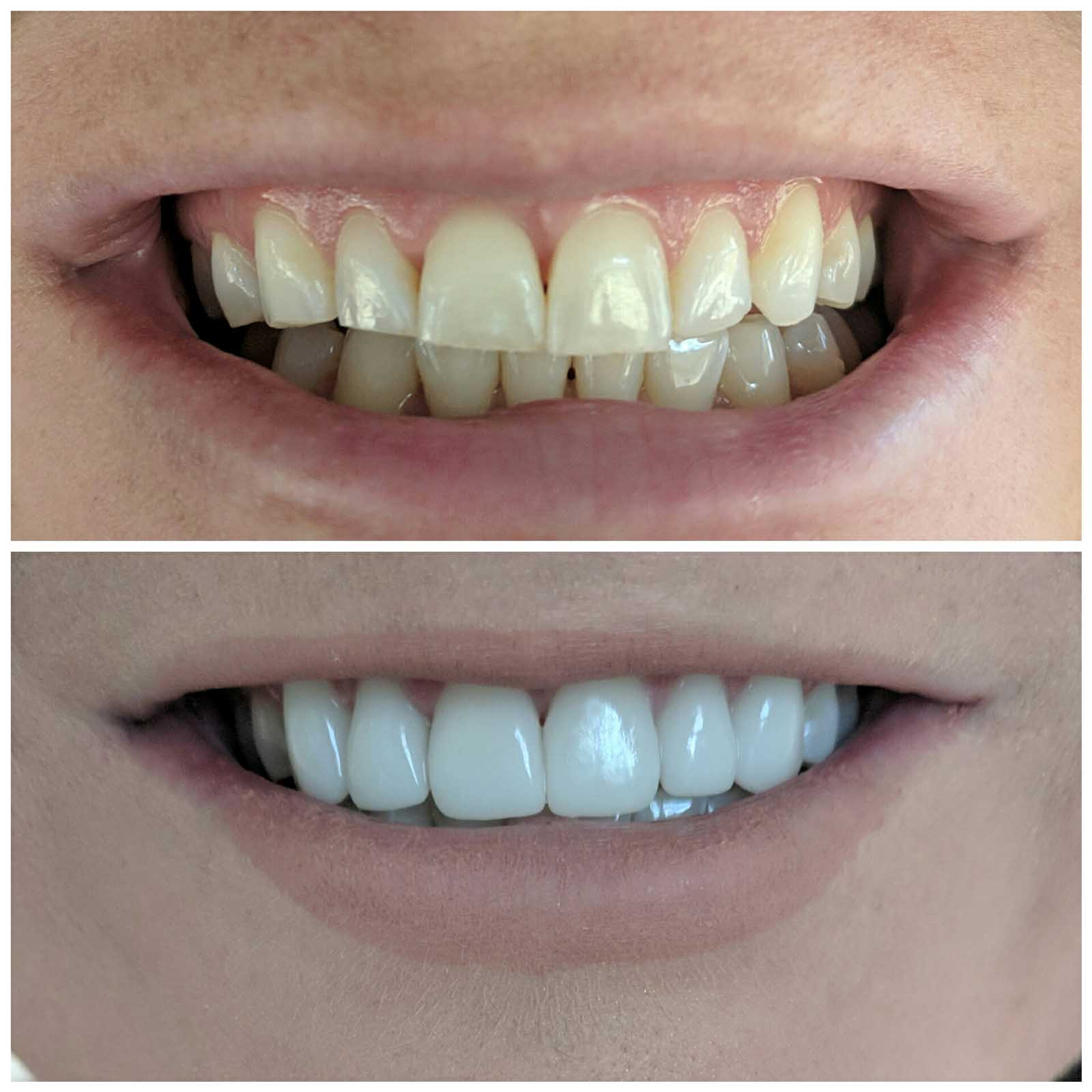 teeth before and after